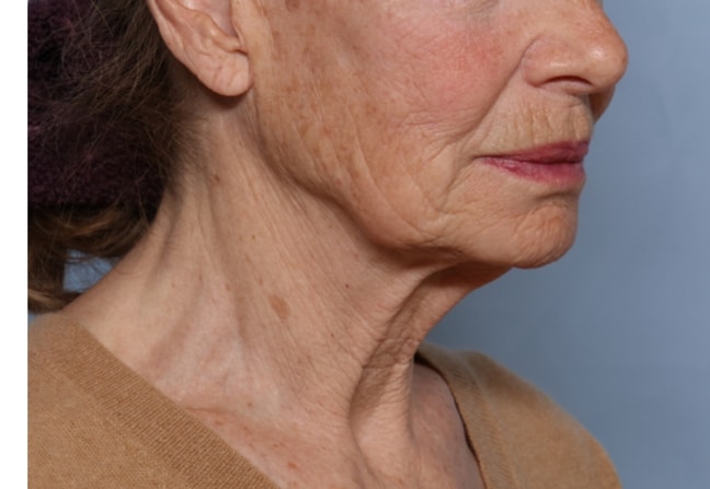 Onda podbrodek przed