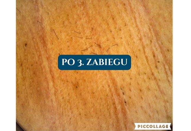 Depilacja laserowa Poznań