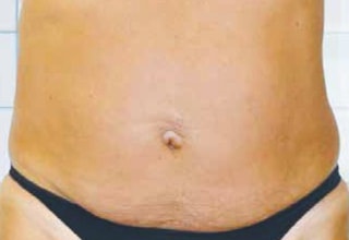 OndaPRO_brzuch_after