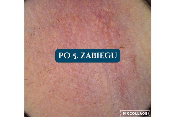 Depilacja laserowa Poznań