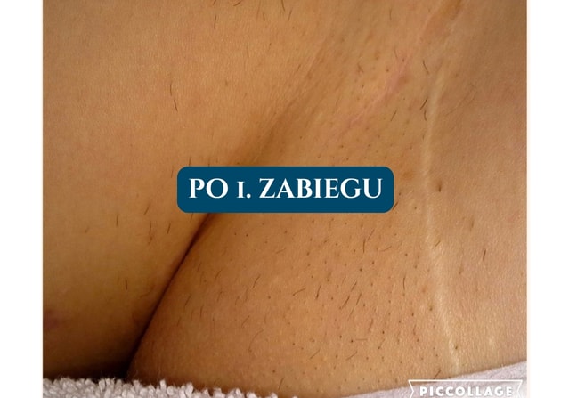Depilacja laserowa Poznań