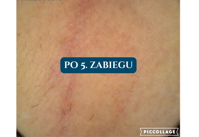 Depilacja laserowa Poznań