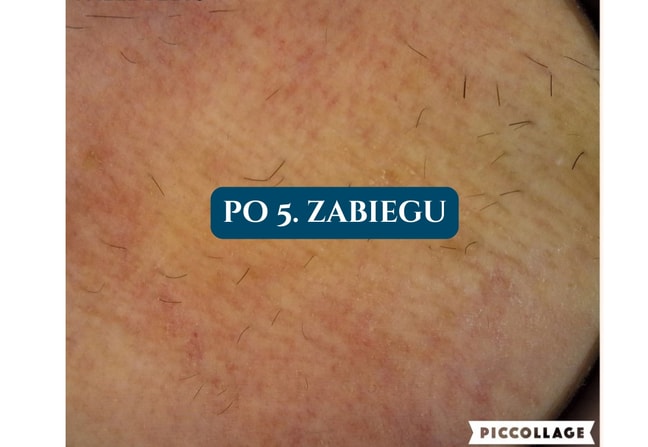 Depilacja laserowa Poznań