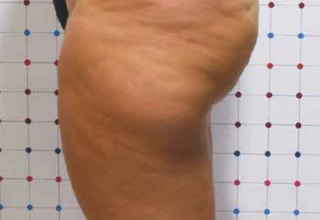 OndaPRO_cellulit_before