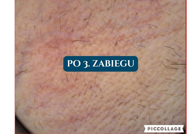 Depilacja laserowa Poznań