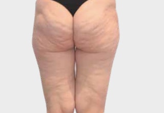 OndaPRO_nogi_cellulit_before