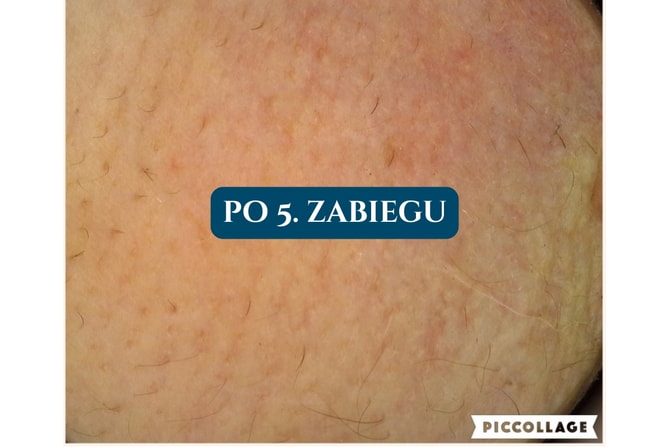 Depilacja laserowa Poznań
