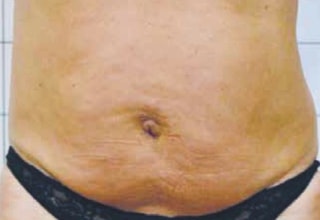 OndaPRO_brzuch_before